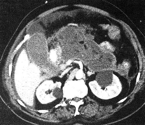 Компьютерная томограмма пациента с тяжелым панкреонекрозом