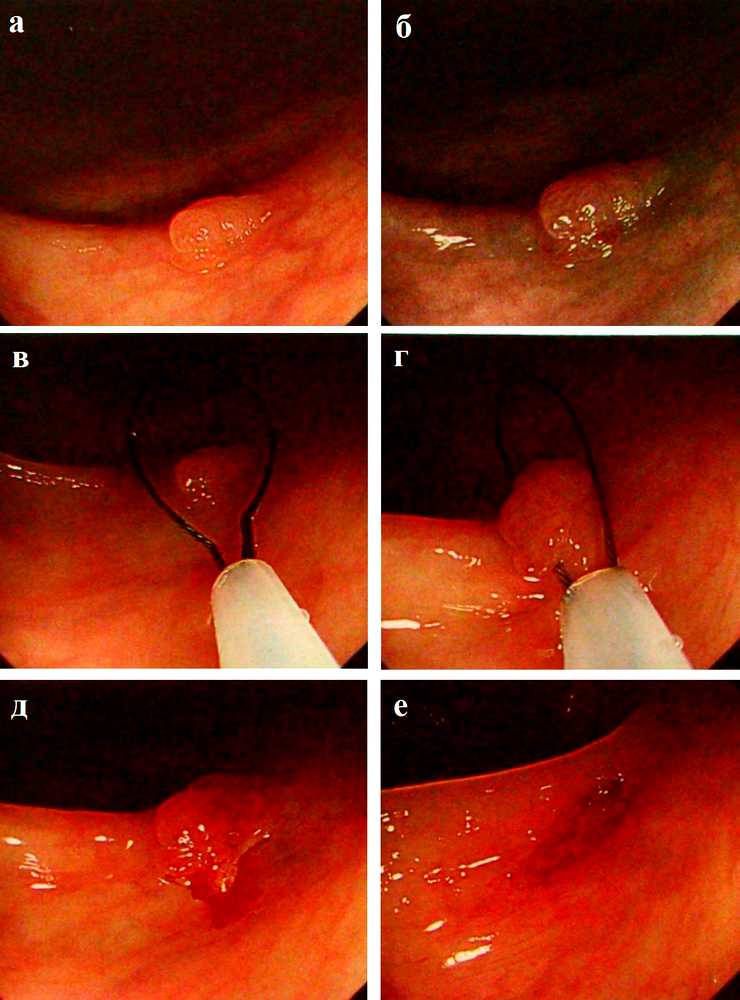 Полипэктомия «холодной» петлей маленькой зубчатой аденомы