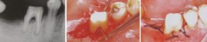 Отмечается дефект бифуркации III класса в области зуба 46