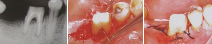 Дефект бифуркации III класса в области зуба 46