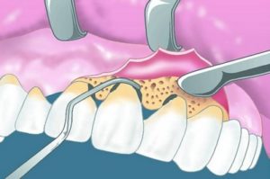 Открытый кюретаж: преимущества в стоматологии