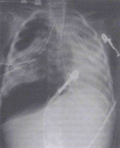 Рентгенограмма грудной клетки показывает напряженный пневмоторакс у пациента с острым респираторным дистресс-синдромом