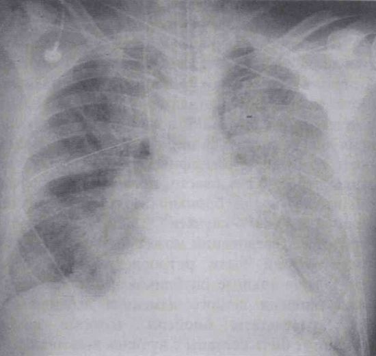 Рентгенограмма грудной клетки у пациента с острым респираторным дистресс-синдромом