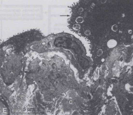 Образец ткани легкого, полученный от пациента во время фазы фиброзного альвеолита
