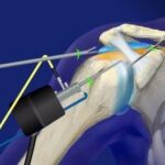 Операции на плечевом суставе и анестезия